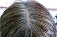 为什么白发越多，恢复的时间越长